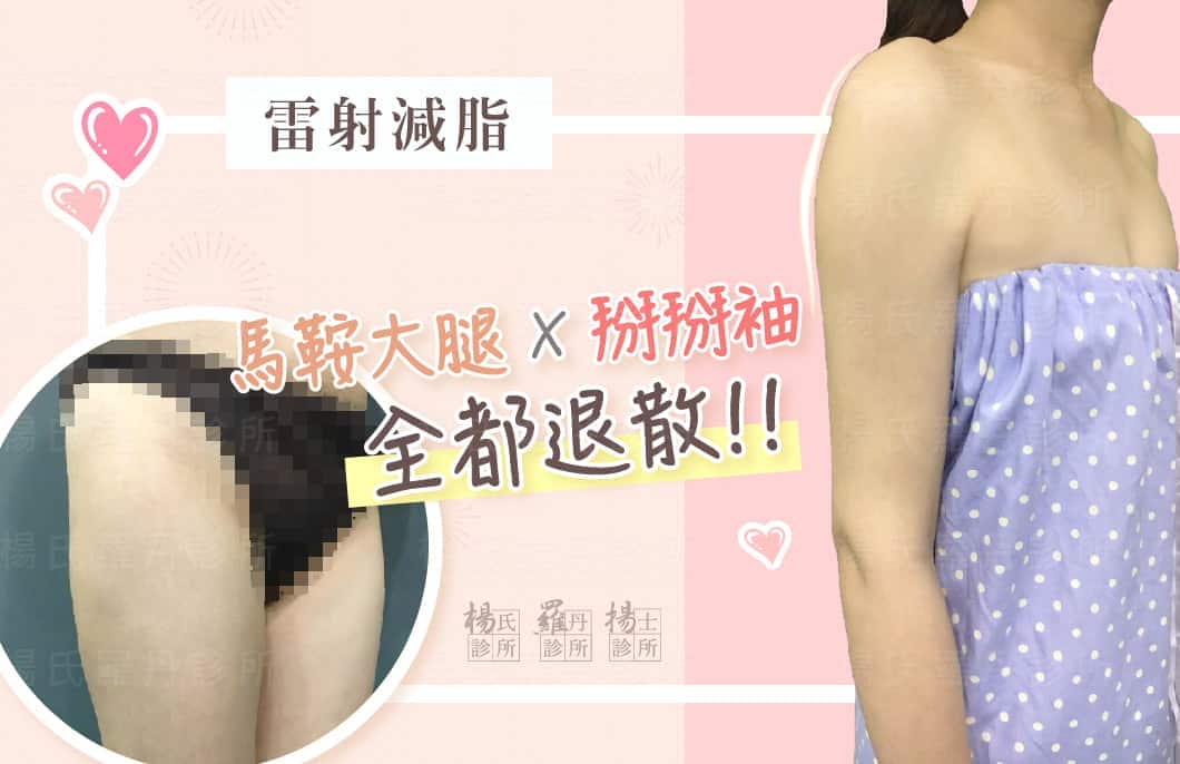 【雷射減脂】掰掰袖與馬鞍大腿全都退散！